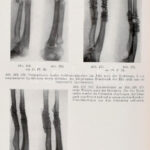 Böhler, Lorenz: Technik der Knochenbruchbehandlung im Frieden und im Kriege, I. Wien, 1941. Wilhelm Maudrich, Wien, 802p. Kiadói vászonkötésben. - Image 3