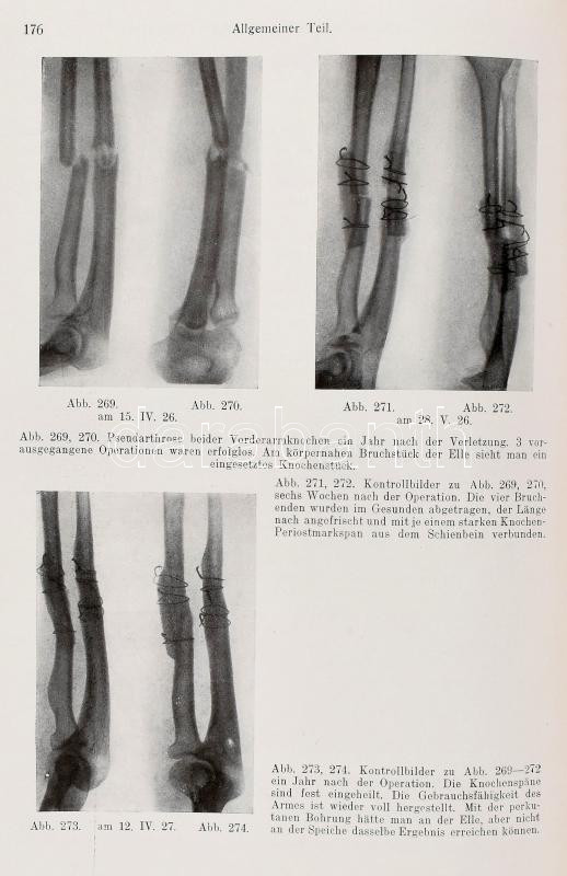 Böhler, Lorenz: Technik der Knochenbruchbehandlung im Frieden und im Kriege, I. Wien, 1941. Wilhelm Maudrich, Wien, 802p. Kiadói vászonkötésben. - Image 3